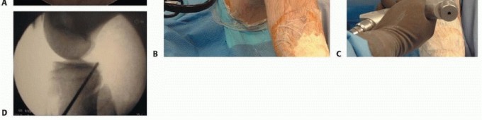 Illustration 11 for Posterior Cruciate Ligament Surgery: Regain Knee Strength & Stability