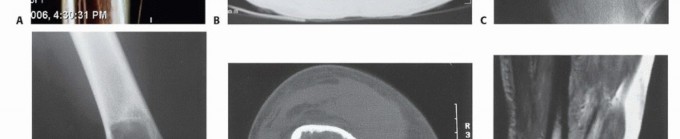 Illustration 20 for Understanding Benign Bone Tumors: Your Complete Preoperative Guide