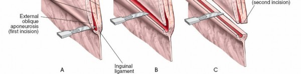 Illustration 67 for Pelvis & Acetabulum Approaches: Unlocking the Posterior Superior Iliac