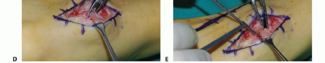 Illustration 5 for Mastering Midfoot Arthrodesis: Protect the Deep Neurovascular Bundle