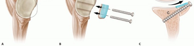 Illustration 8 for Latarjet for Instability: Bone Loss Solutions, Per Burkhart SS, Lo