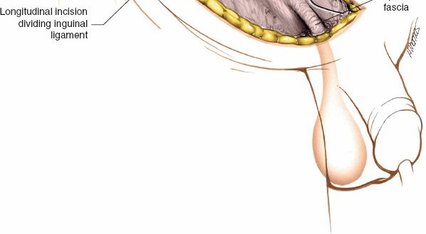 Illustration 60 for Pelvis & Acetabulum Approaches: Unlocking the Posterior Superior Iliac
