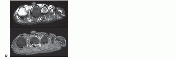 Illustration 9 for Plantar Plate Repair: End Lesser Toe Pain & Instability