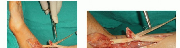 Tibialis Anterior Tendon Rupture: From Diagnosis to Full Recovery