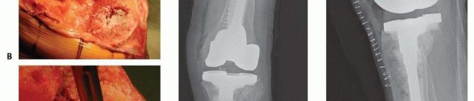 Illustration 5 for Bone Loss Bone Grafting for Challenging Tibial Defects