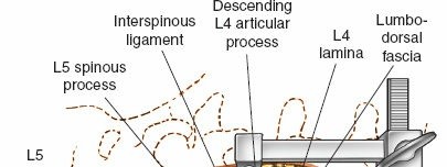 Illustration 10 for Approach to the Lumbar Spine: Mastering Techniques & Anatomy