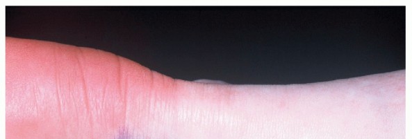 Unlocking Healing: Med Maffulli N on Open Achilles Tendinopathy