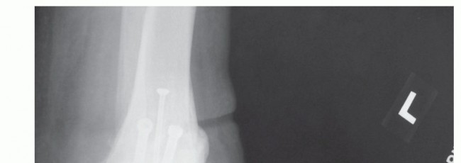Illustration 7 for Unlock Stability: Medullary Nail Fixation for Tibiotalocalcaneal Arthrodesis