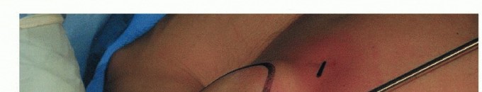 Illustration 20 for Is Your Dorsal Scapular Nerve Causing Snapping Scapula Pain?