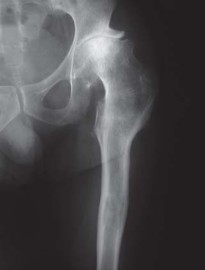 Illustration 41 for S-ROM: Inside the Technique of Modular Implant Design