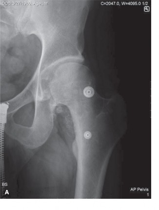 Don't Miss Synovial Chondromatosis in Orthopedics Oncology Cases