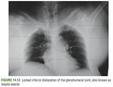 Inferior Glenohumeral Dislocation: Symptoms, Diagnosis & Treatment