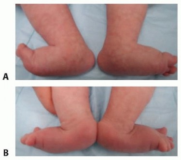 Comprehensive Treatment of Vertical Talus: What Works