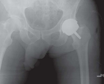 Illustration 80 for Metal on Metal Resurfacing: Enhanced Posterior Soft Tissue Repair