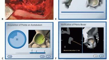 Illustration 23 for Hip Resurfacing: The Bone-Sparing Solution around the Femoral Head