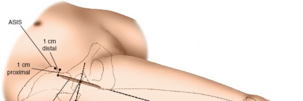 Illustration 81 for Unlocking Every Aspect of the Hip's Surgical Approaches