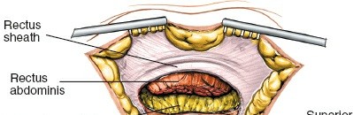 Illustration 19 for Pelvis & Acetabulum Approaches: Unlocking the Posterior Superior Iliac