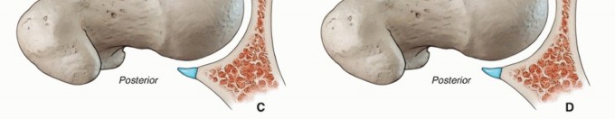 Illustration 8 for Hip Arthroscopy: Your Minimally Invasive Solution for Hip Pain