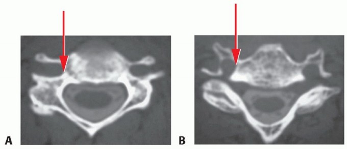 Illustration 18 for How ACDF Clears Your Posterior Disc Space for Lasting Relief
