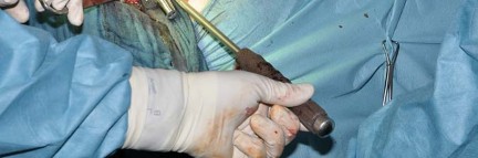 Illustration 66 for Collum Femoris Preserving: Achieve Better Primary Hip Outcomes