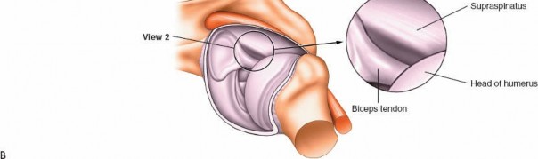 Illustration 229 for Essential Guide: Mastering Every Approach to the Shoulder