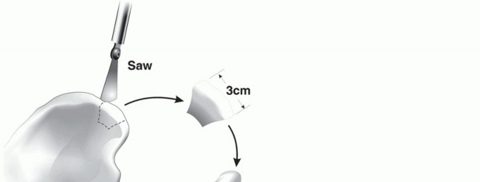 Illustration 20 for Glenoid Bone Graft for Anterior Shoulder Instability: Restore Stability