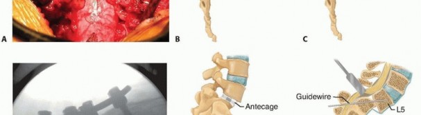 Illustration 18 for Mastering High-Grade Spondylolisthesis: Posterolateral and Interbody Fusion
