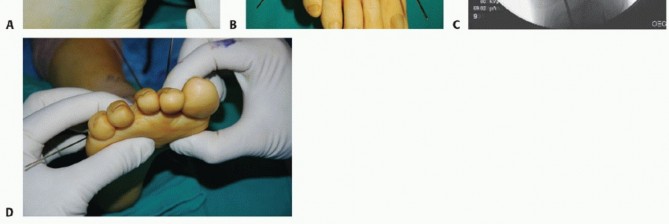 Illustration 16 for Mastering Midfoot Arthrodesis: Protect the Deep Neurovascular Bundle