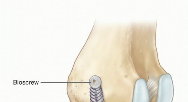 Illustration 13 for Repair & Recover from Collateral Ligament Injuries: Your Guide