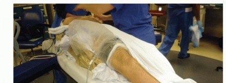 Illustration 17 for Unlock Stability: Medullary Nail Fixation for Tibiotalocalcaneal Arthrodesis