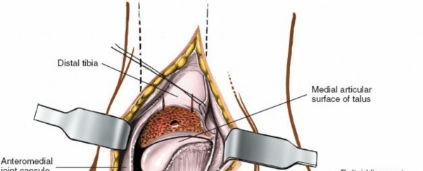 Illustration 9 for Step-by-Step Medial Side of the Ankle Approach Guide