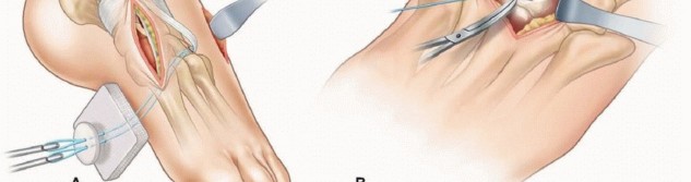 Illustration 15 for Why Anterior Tibialis Muscle Transfer Fixes Clubfoot