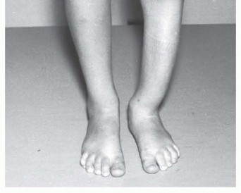 Illustration 2 for Williams Rod: Achieve Stability for Pseudarthrosis within the Tibia