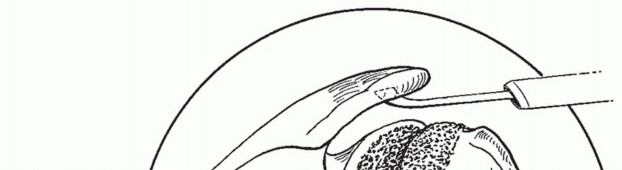 Glenohumeral Arthrodesis: Maximize Function, ed Philadelphia Lippincott