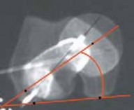 Illustration 5 for Increased Femoral Anteversion: A Proximal Femoral Rotational Osteotomy