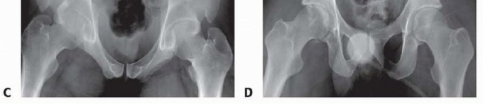 Illustration 5 for Achieve Stable Fixation of the Symphysis: Open Reduction