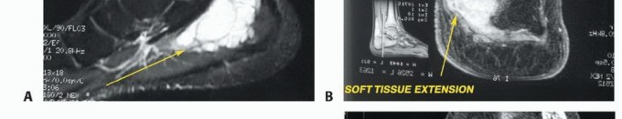 Illustration 10 for Treating Tumors of the Foot: Optimizing Amputation & Resection