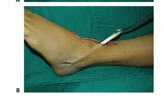 Illustration 48 for Foot Drop Surgery: How a Pin or Drill Elevates Tendon Transfer