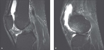Unraveling Knee Injuries: Insights from the Lateral Femoral Condyle