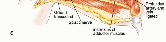 Illustration 14 for Optimizing Adductor Muscle Group Resection for Limb Preservation