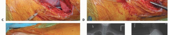 Illustration 42 for Anterior Interbody Arthrodesis for Scoliosis: What You Need to Know