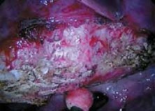 Illustration 16 for Mastering Anterior Interbody Arthrodesis with Instrumentation for Scoliosis