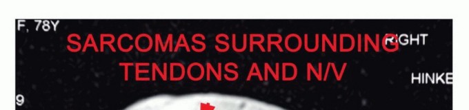 Illustration 12 for Above-Elbow & Below-Elbow Amputations: When & Why They're Needed