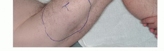 Illustration 11 for Limb-Sparing Quadriceps Resection: Superficial Femoral Artery