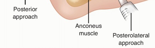 Illustration 18 for Radial Head & Neck Fractures: Mastering ORIF for Best Results