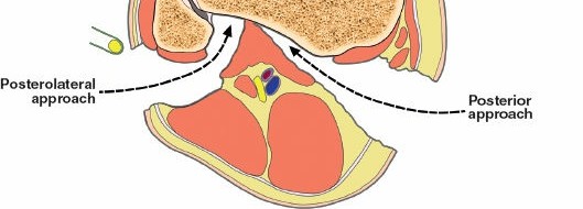 Illustration 6 for Surgical Access: Mastering the Tibia's Surface & Fibula Approaches