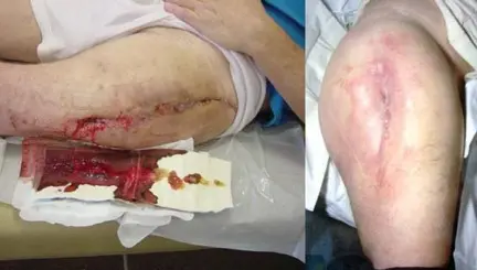 علاج عدوى مفصل الورك الصناعي: دليل شامل لمراجعة المفصل على مرحلتين مع الأستاذ الدكتور محمد هطيف في صنعاء