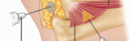Illustration 17 for Radial Head & Neck Fractures: Mastering ORIF for Best Results