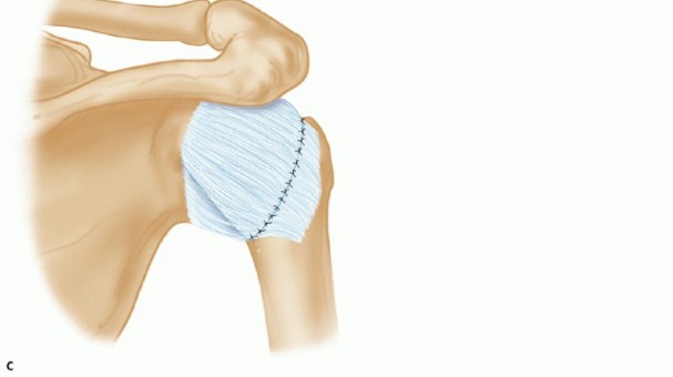 Illustration 20 for Finally Treat Recurrent Posterior Instability of the Shoulder