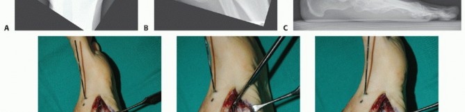 Illustration 71 for Mastering Midfoot Arthrodesis: Protect the Deep Neurovascular Bundle